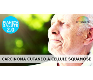 Carcinoma cutaneo a cellule squamose. PIANETA SALUTE 2.0 169a puntata